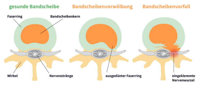 Welche Matratze Bandscheibenvorfall